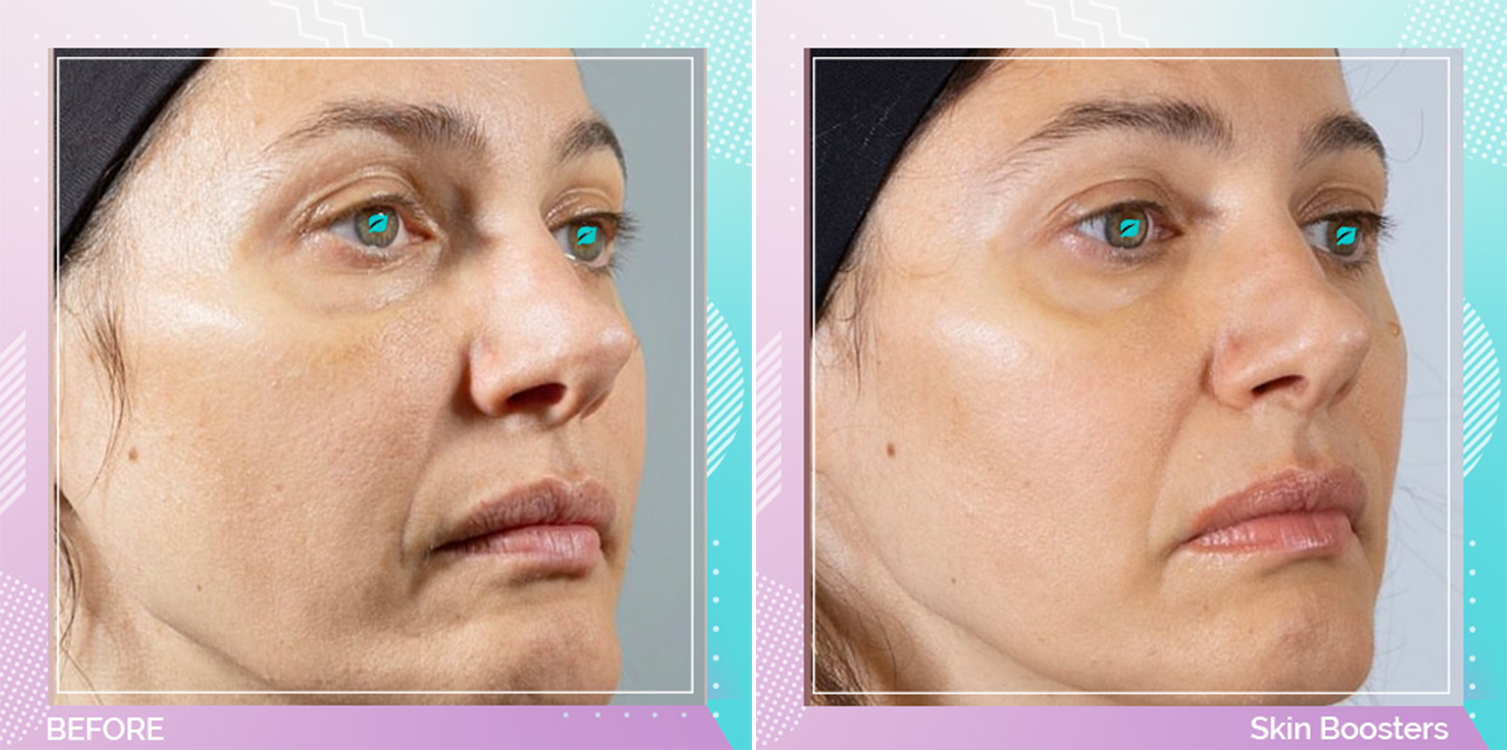 Skin Boosters before and after, Face