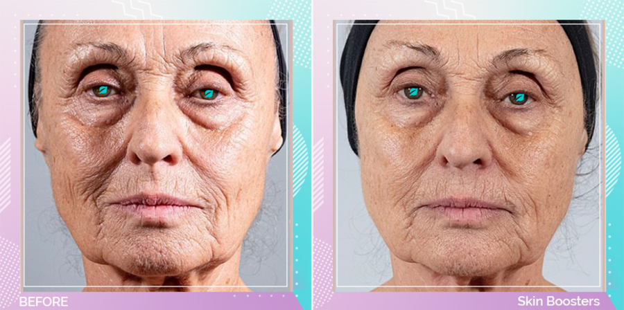 Skin Boosters before and after, Face