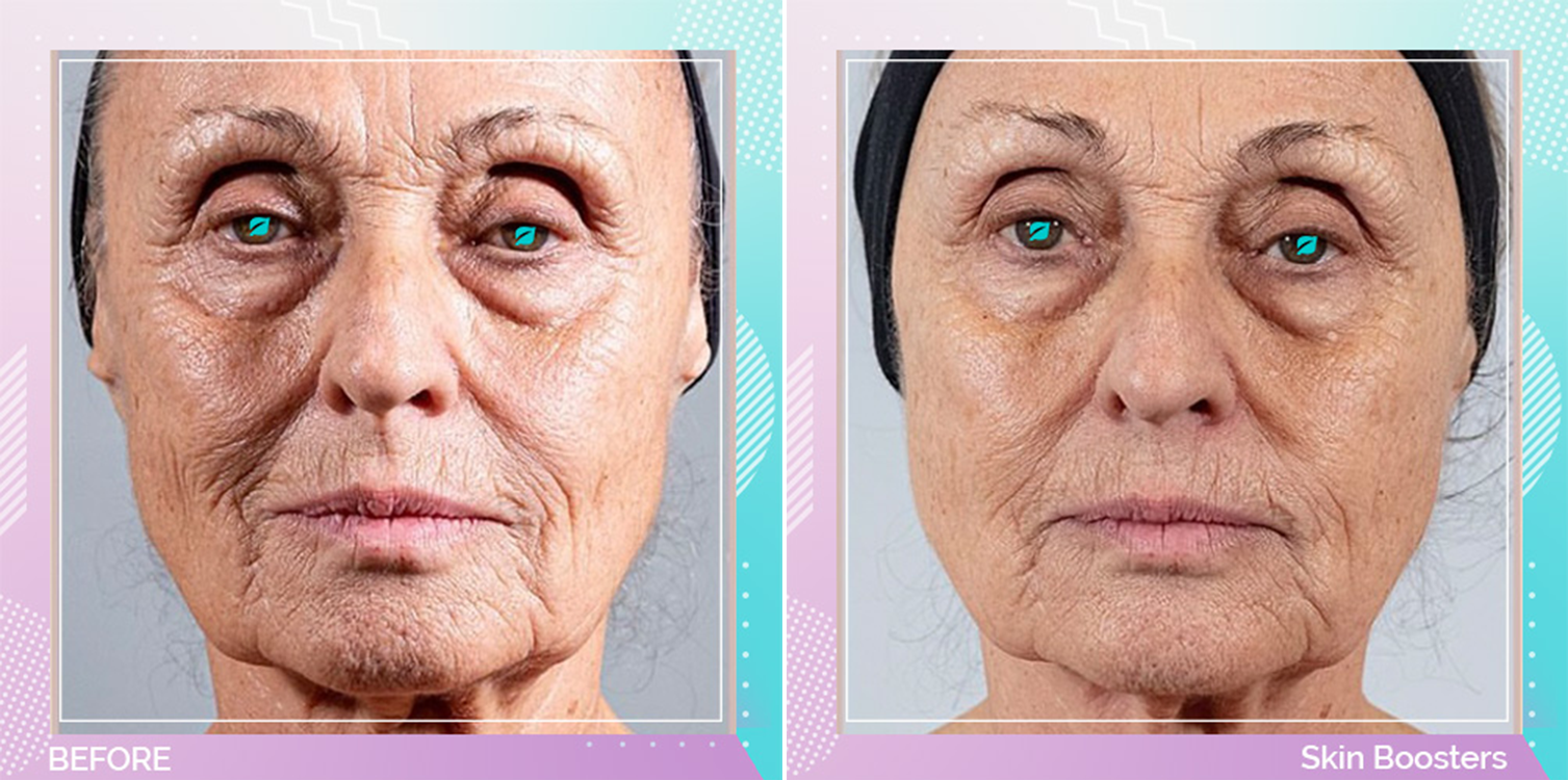 Skin Boosters before and after, Face