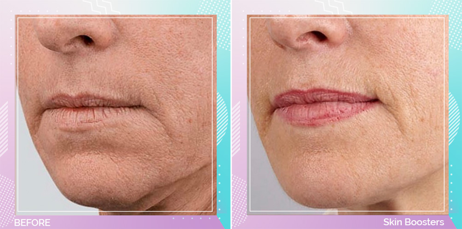 Skin Boosters before and after, Face