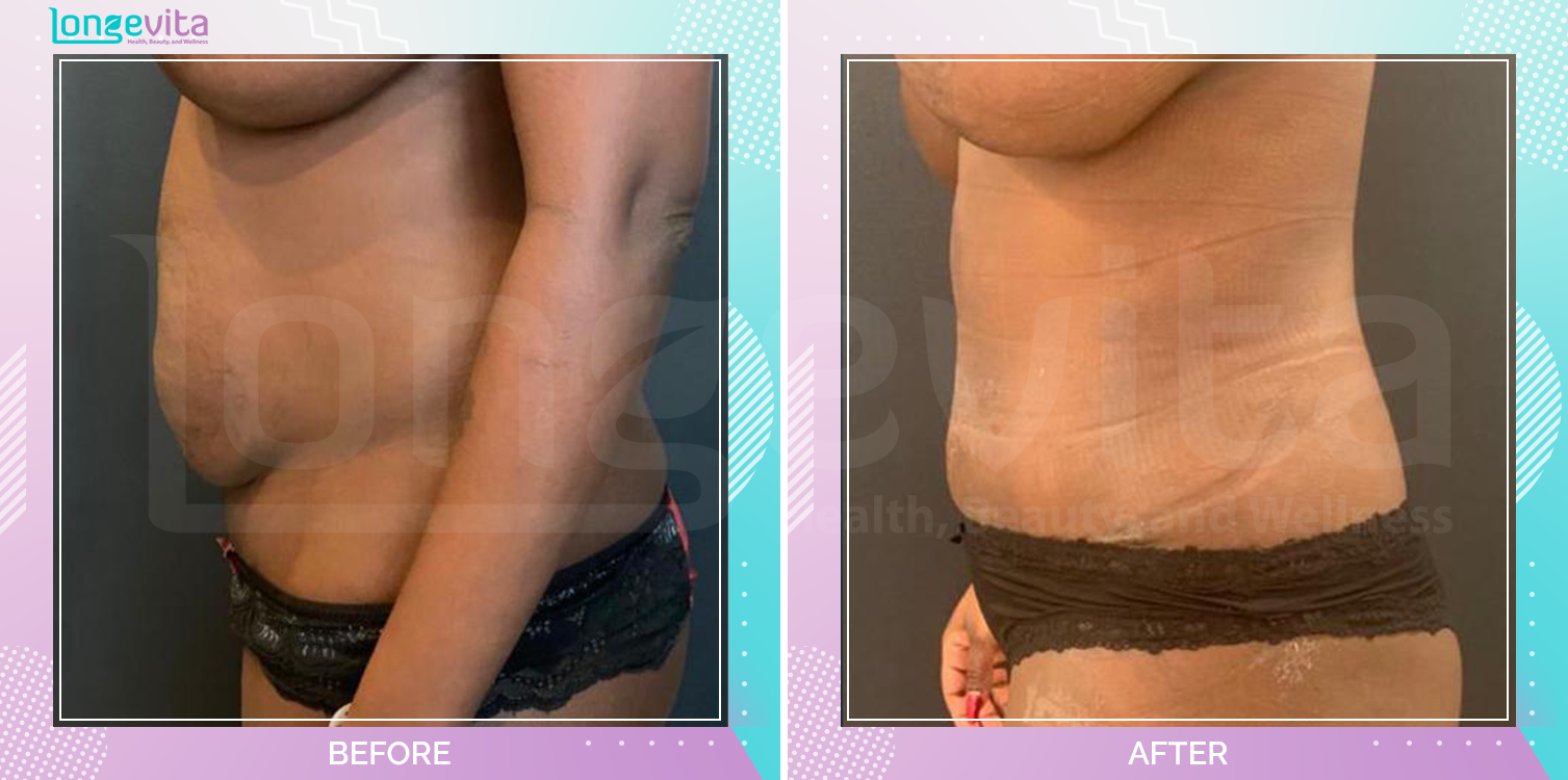 Liposuction and Tummy Tuck before and after, Body