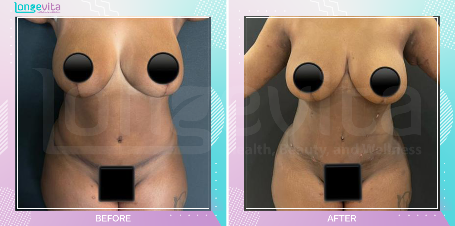 Liposuction and Tummy Tuck before and after, Body