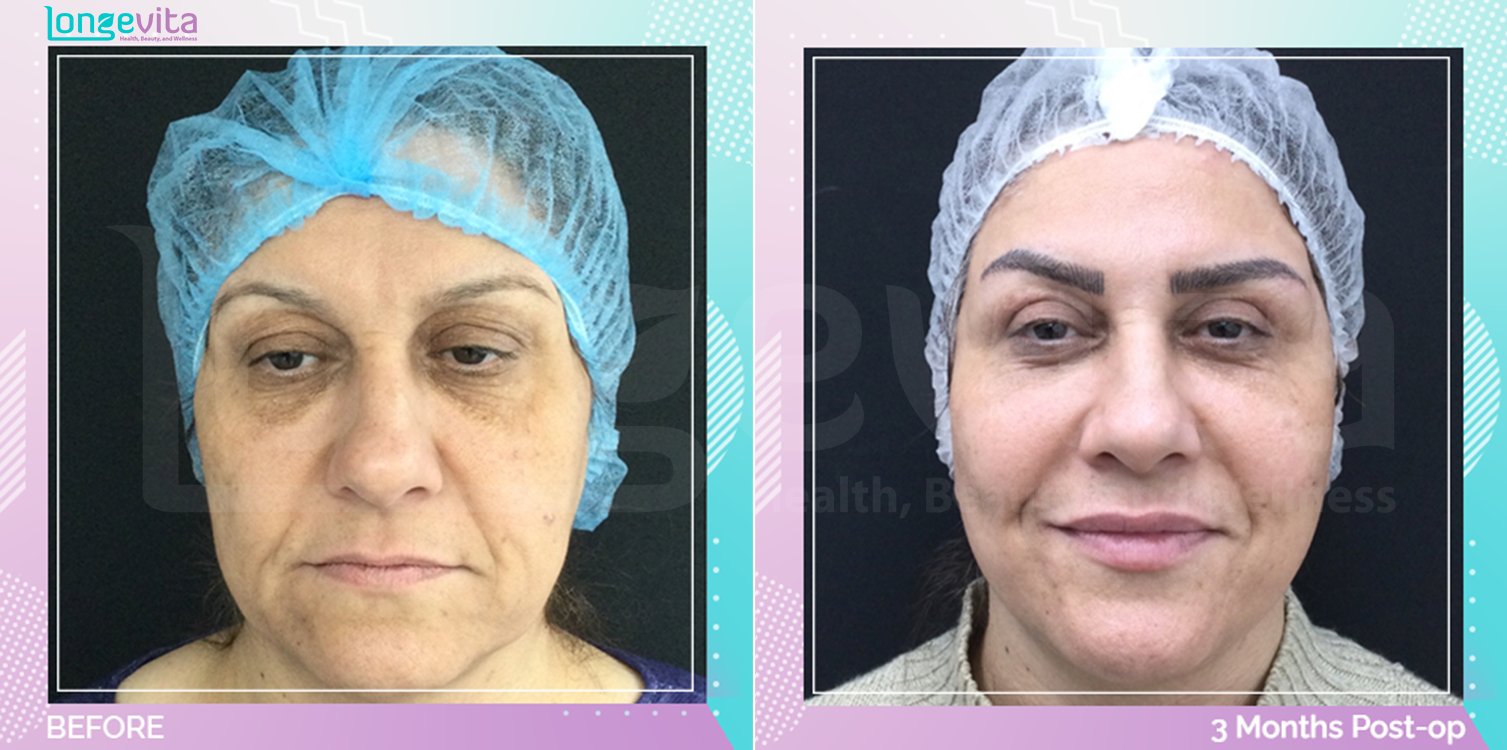 Eyelid and Facelift before and after, Face