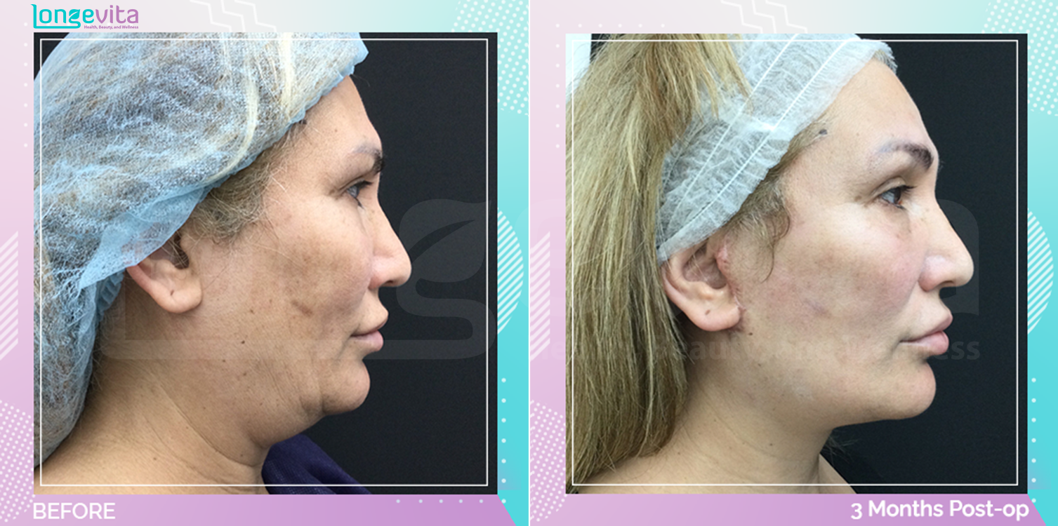 Eyelid and Facelift before and after, Face
