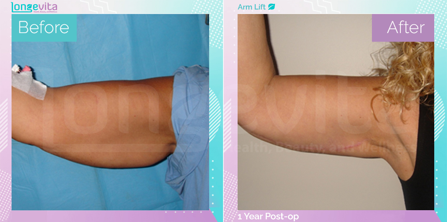 Arm Lift before and after, Body