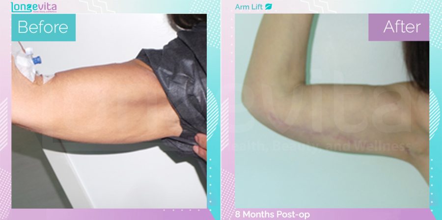 Arm Lift before and after, Body