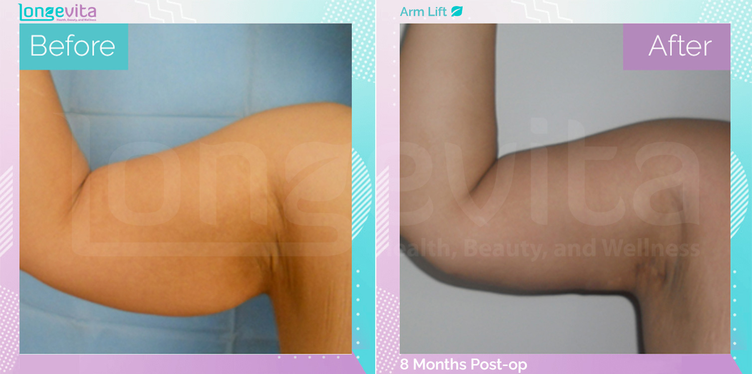 Arm Lift before and after, Body