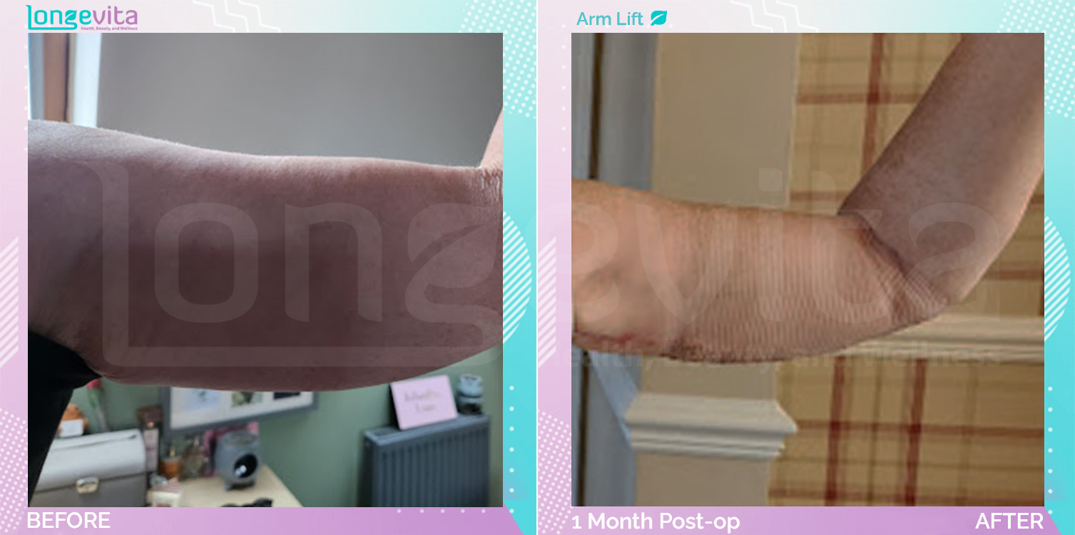 Arm Lift before and after, Body, 60s female patient