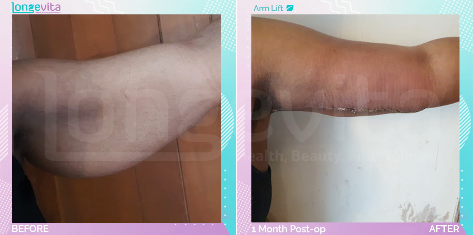 Arm Lift before and after, Body, 40s female patient
