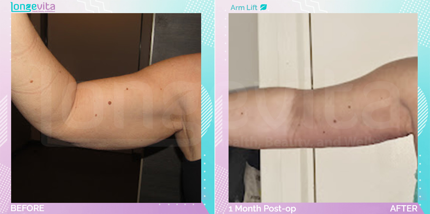 Arm Lift before and after, Body, 40s female patient