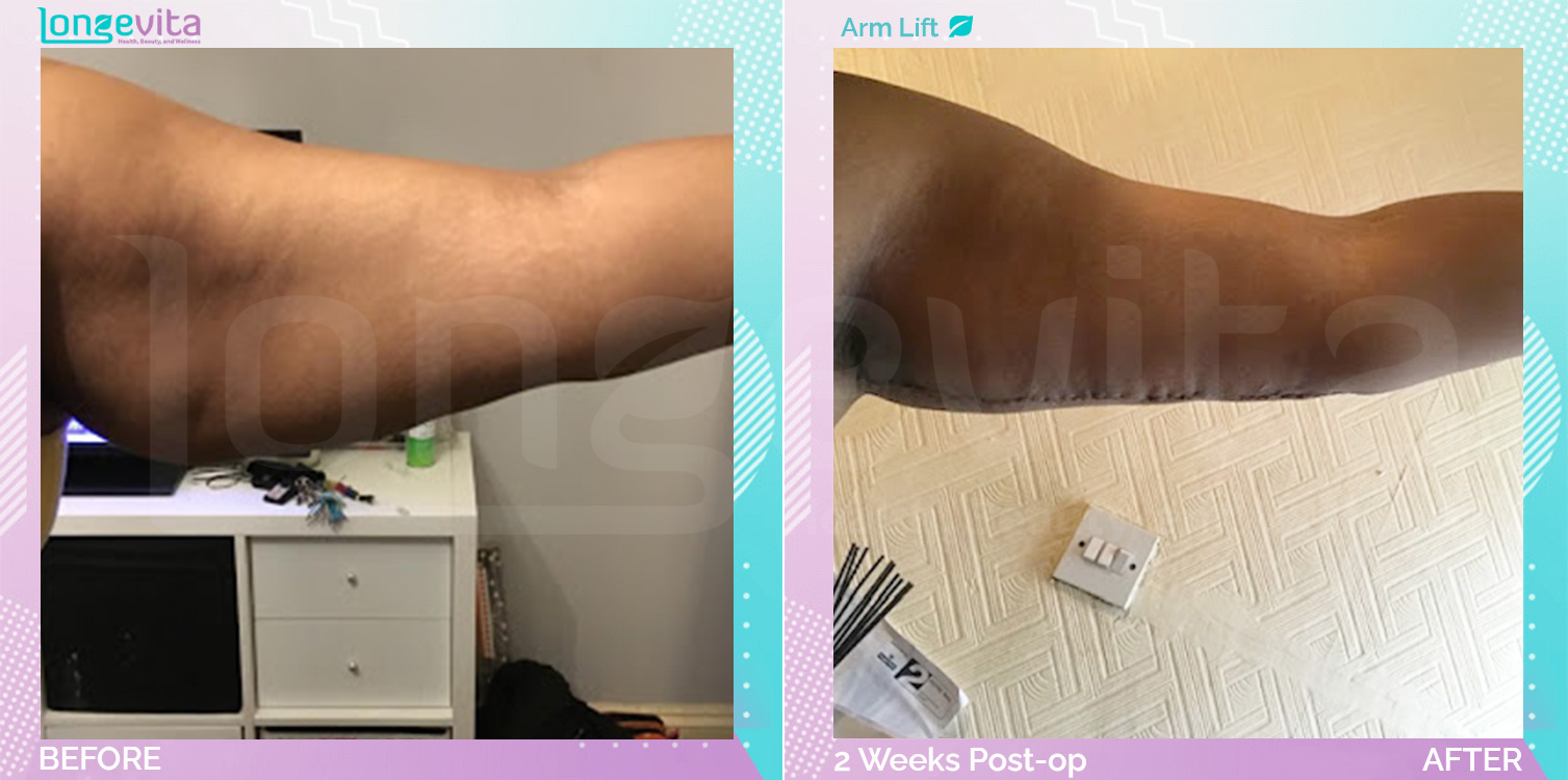 Arm Lift before and after, Body, 20s female patient