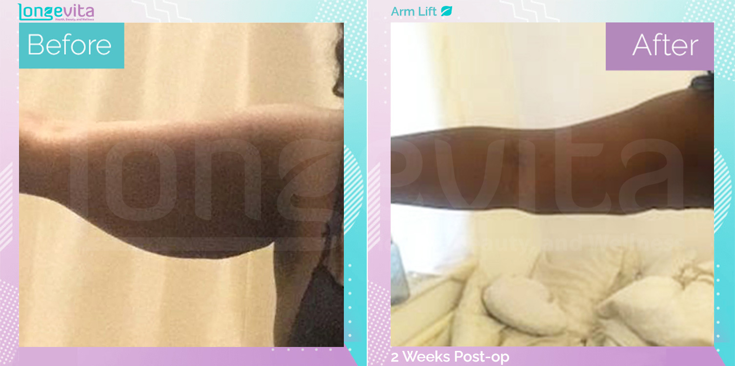Arm Lift before and after, Body