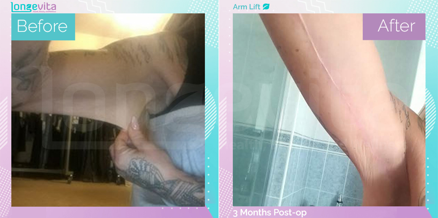 Arm Lift before and after, Body, 40s female patient