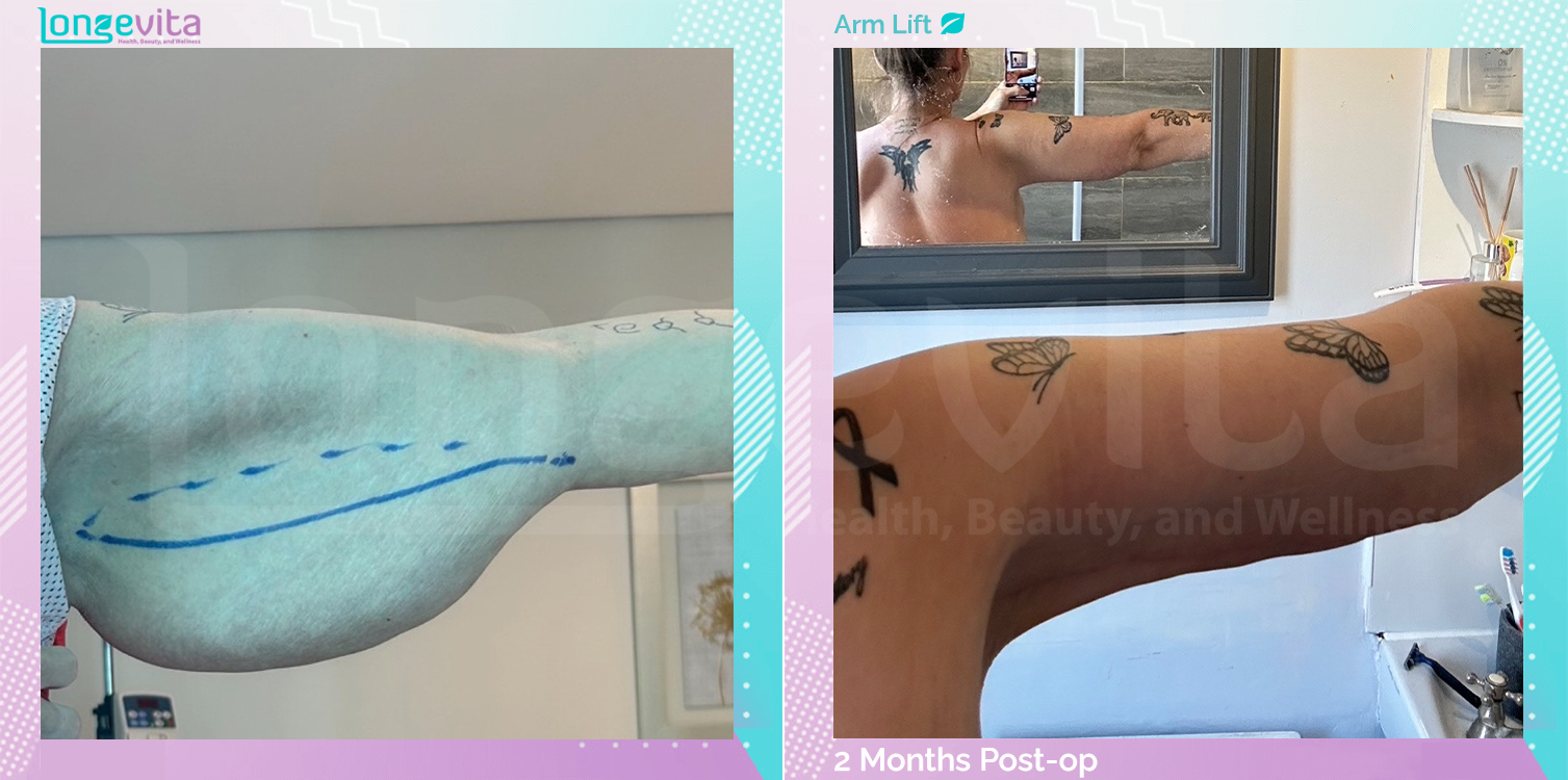 Arm Lift before and after, Body, 40s female patient