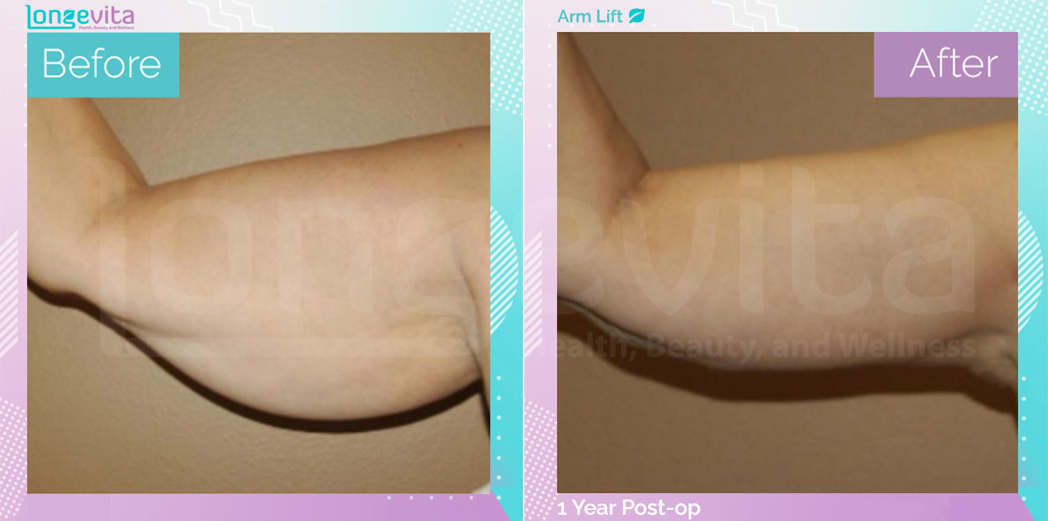 Arm Lift before and after, Body