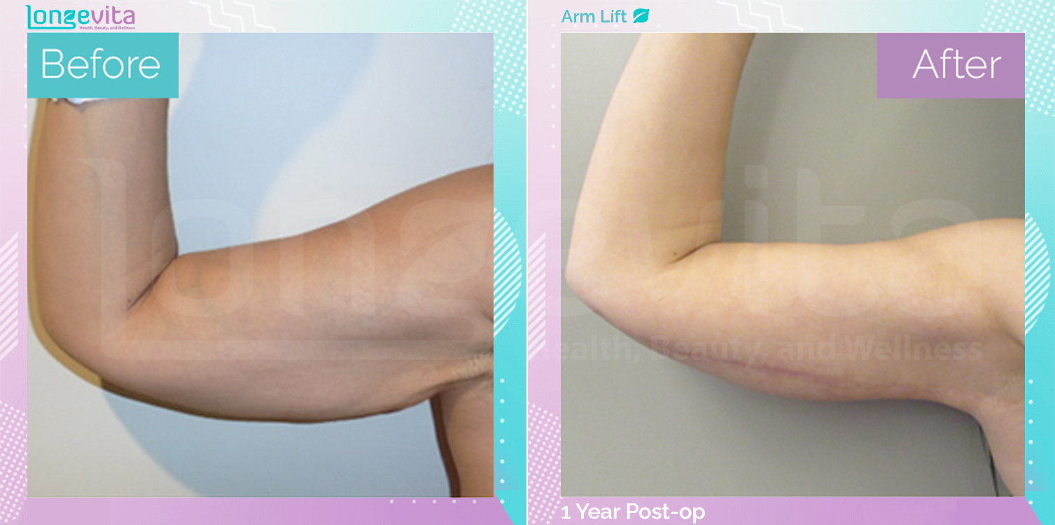Arm Lift before and after, Body