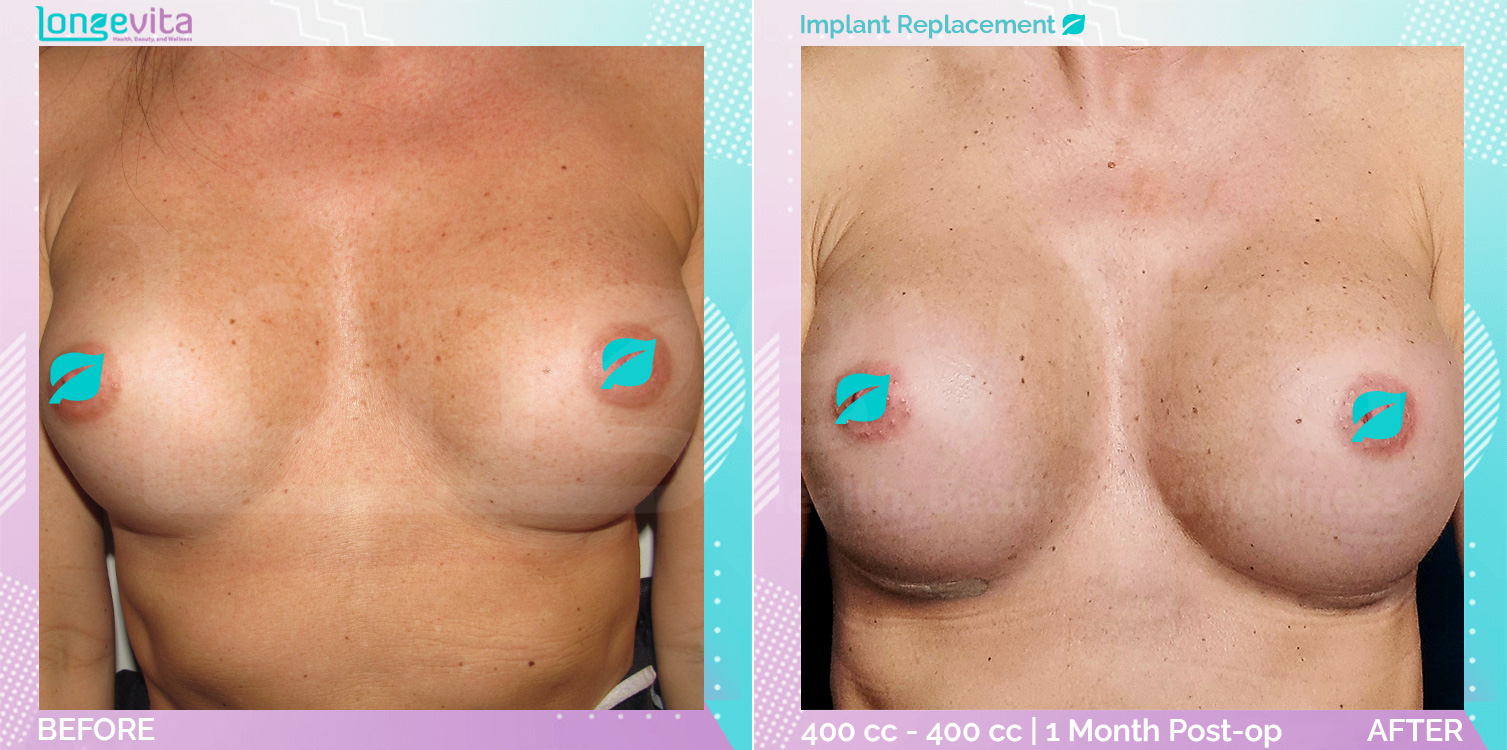Implant Replacement before and after, Breast, 40s female patient