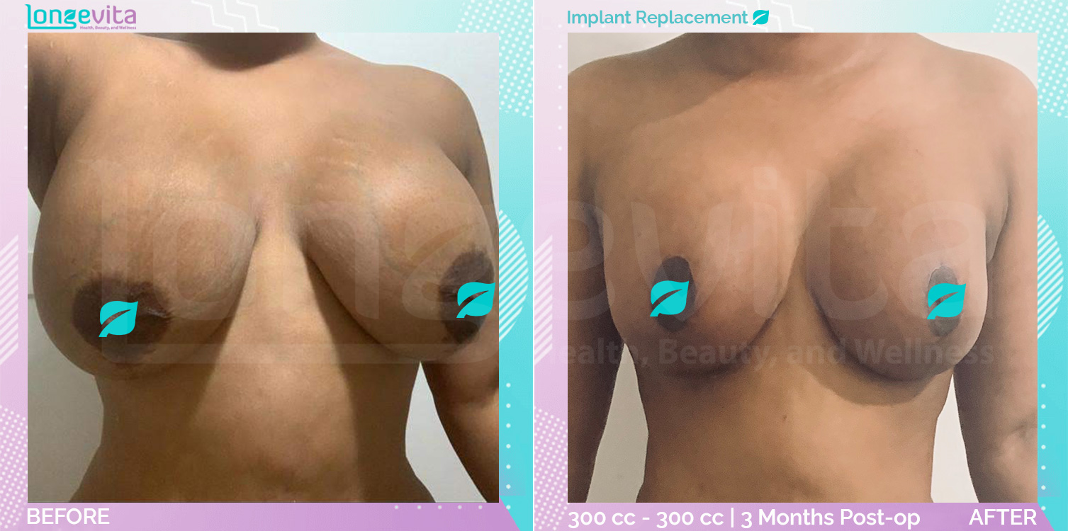 Breast Lift and Implant Replacement before and after, Breast, 30s female patient