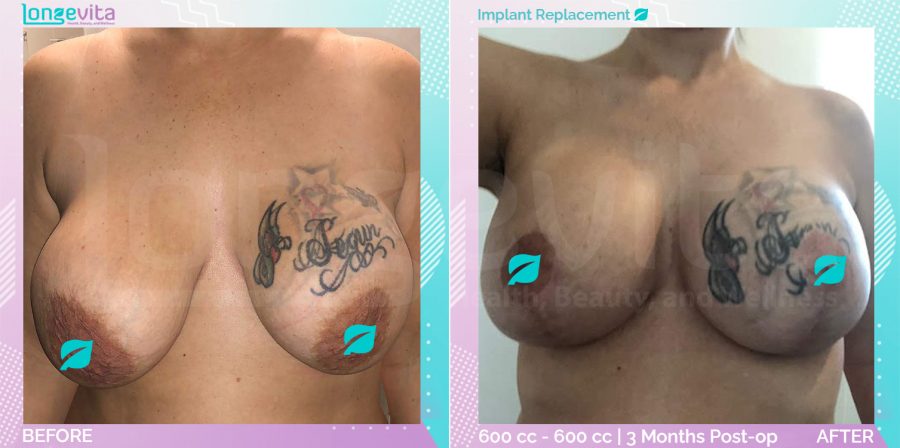 Areola Reduction and Breast Lift and Implant Replacement before and after, Breast, 30s female patient