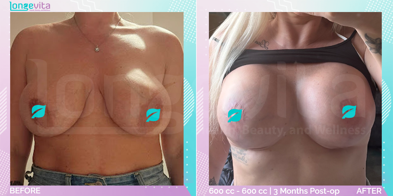 Breast Lift and Implant Replacement before and after, Breast, 30s female patient