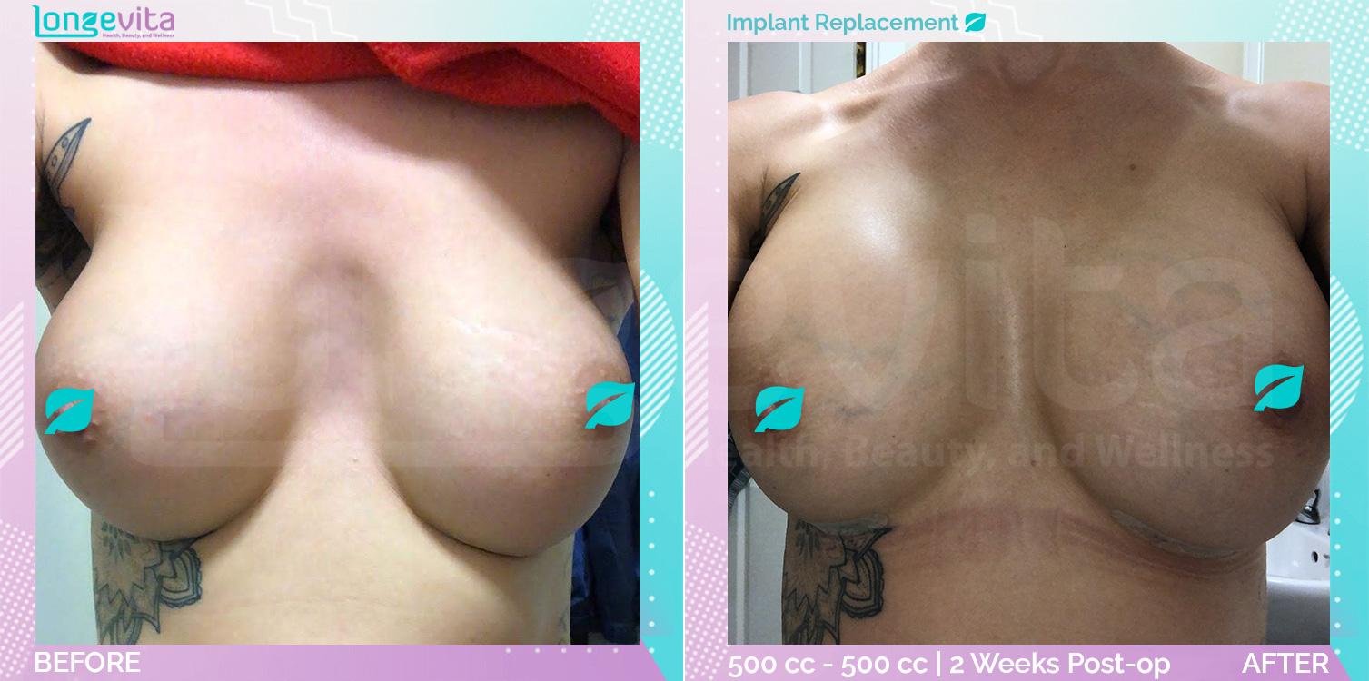 Breast Lift and Implant Replacement before and after, Breast, 30s female patient