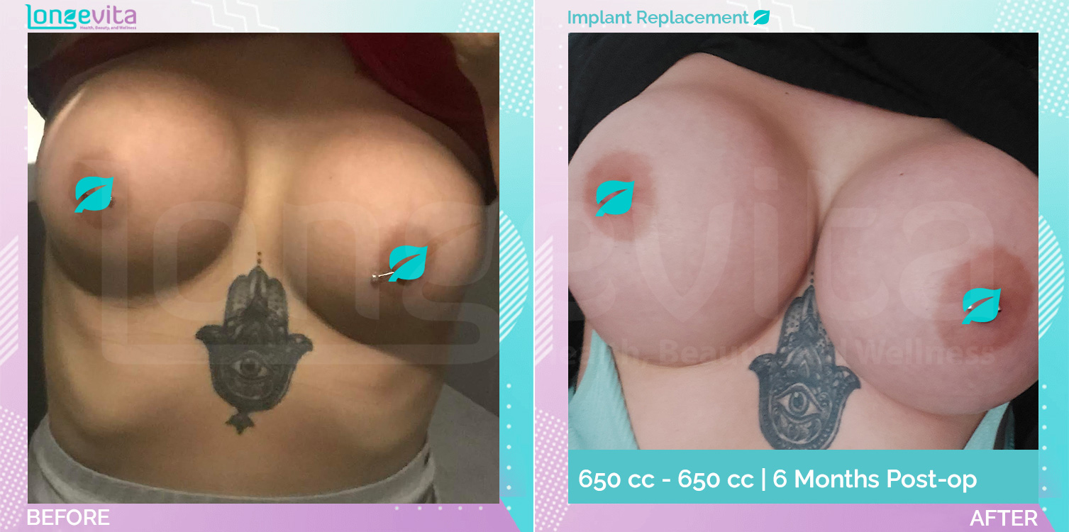 Breast Lift and Implant Replacement before and after, Breast, 20s female patient