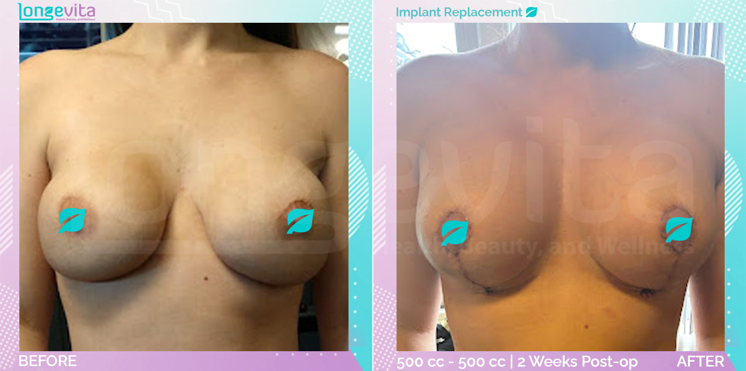 Breast Lift and Implant Replacement before and after, Breast, 30s female patient