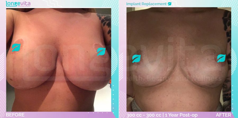 Areola/Nipple Correction and Breast Lift and Implant Replacement before and after, Breast, 20s female patient