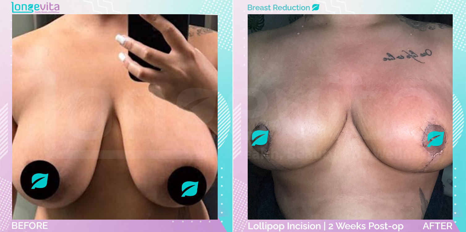 Breast Reduction before and after, Breast, 20s female patient