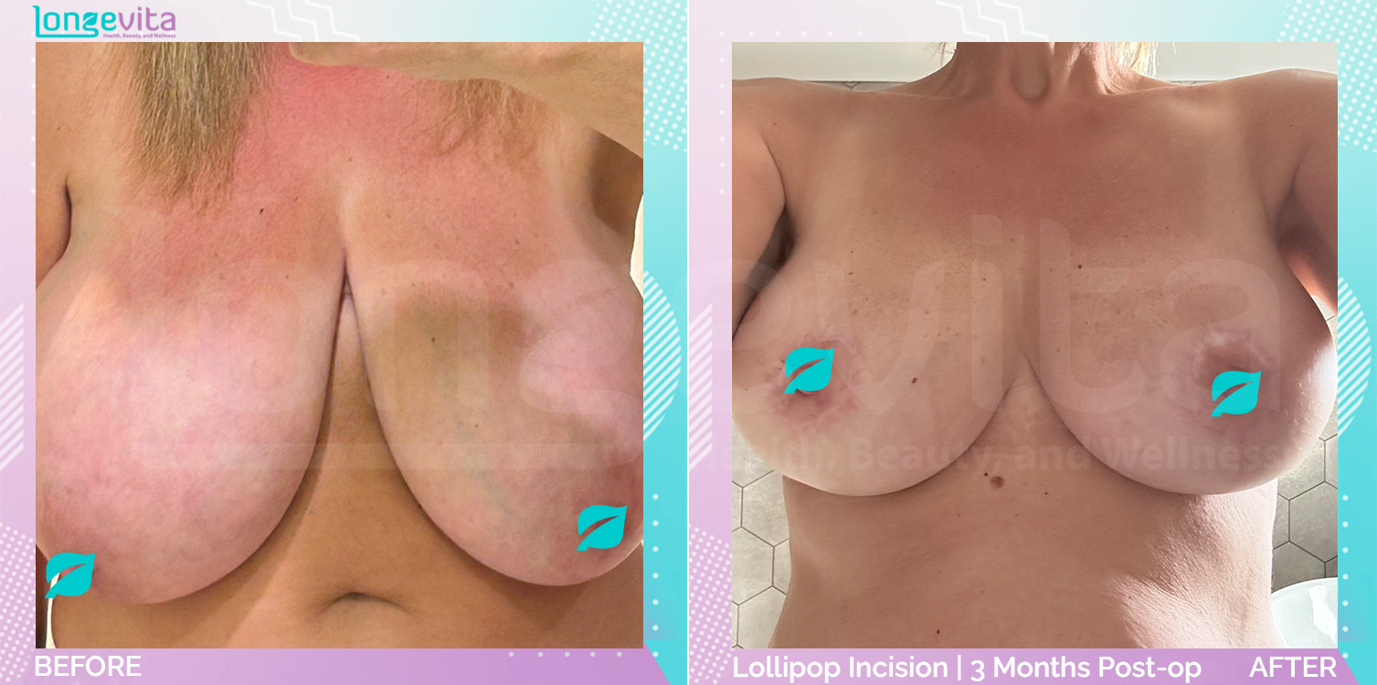 Breast Reduction before and after, Breast, 50s female patient