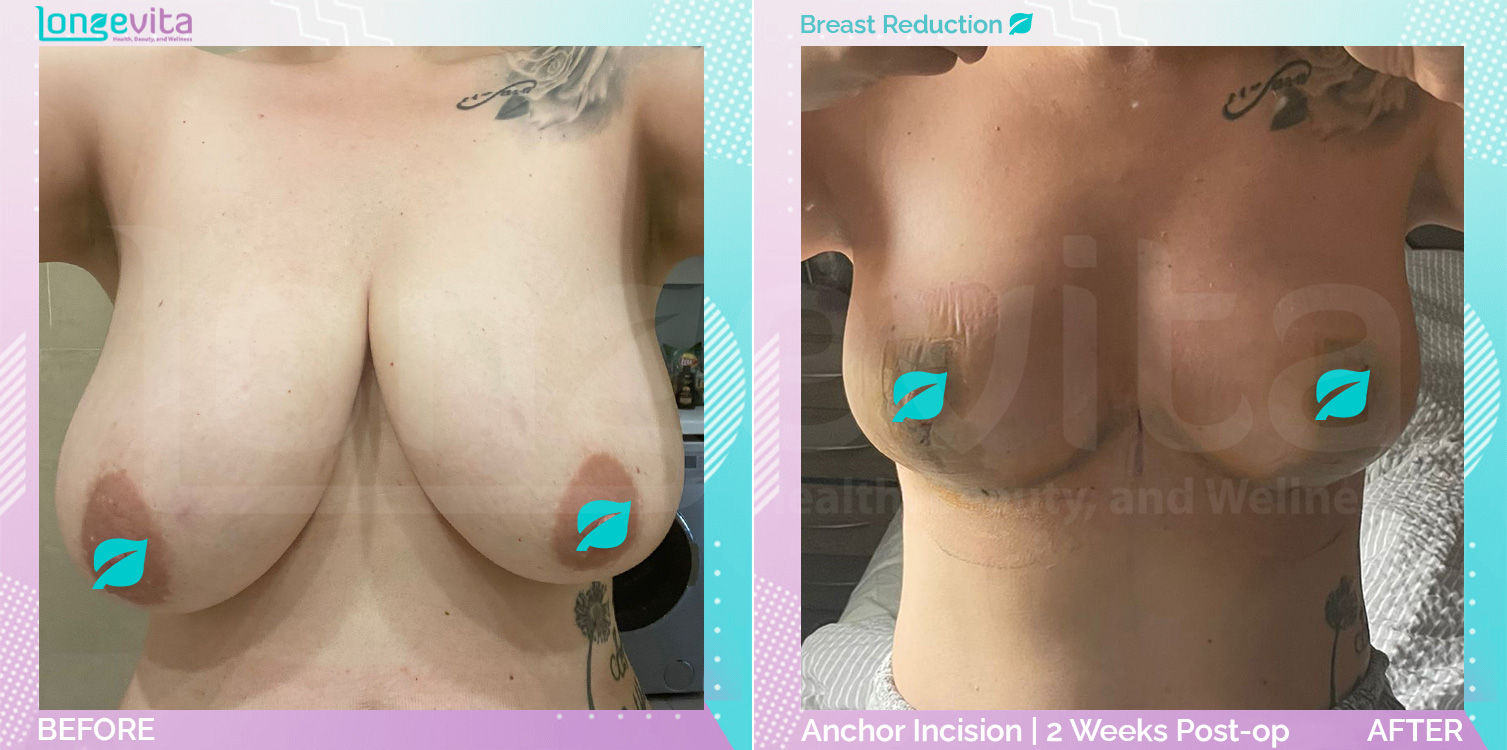 Breast Reduction before and after, Breast, 20s female patient