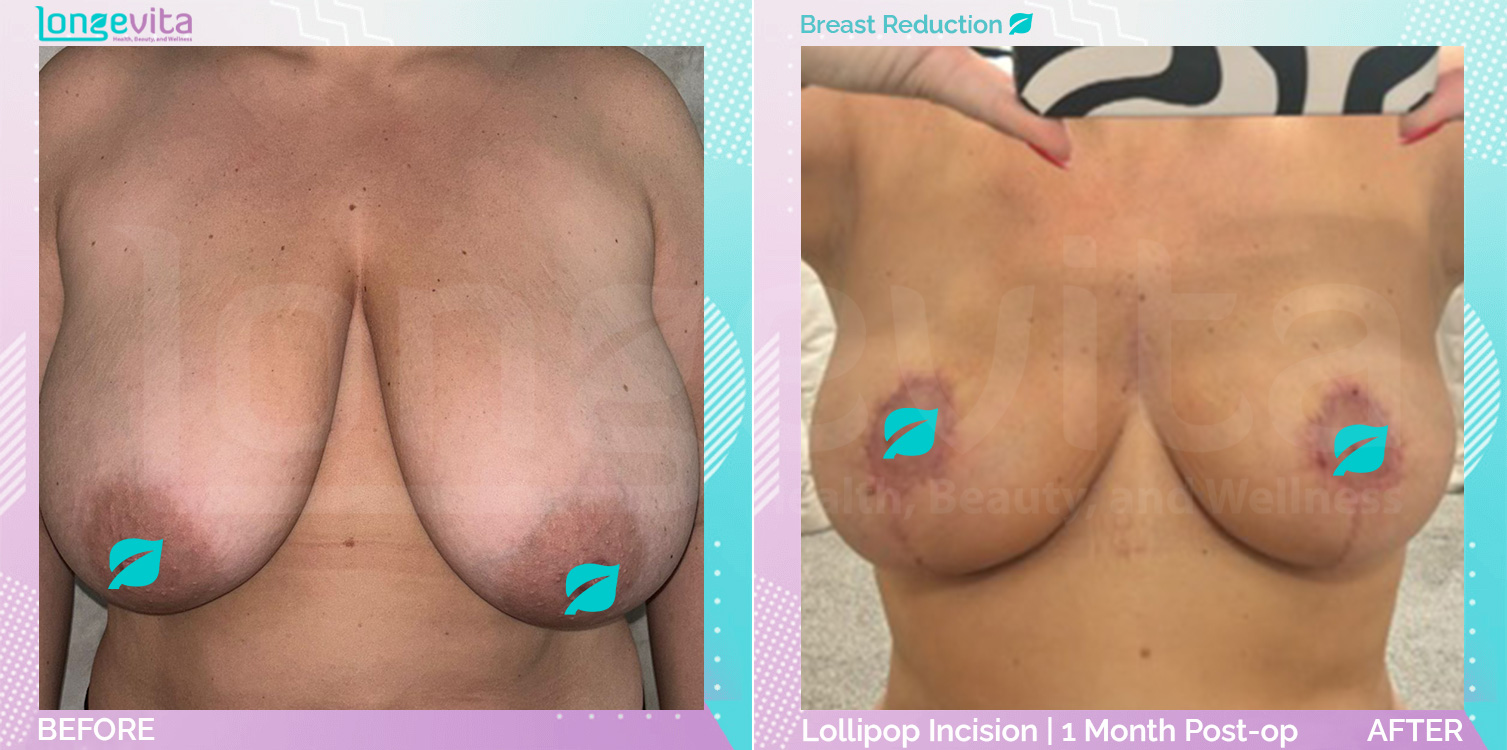 Breast Reduction before and after, Breast, 30s female patient