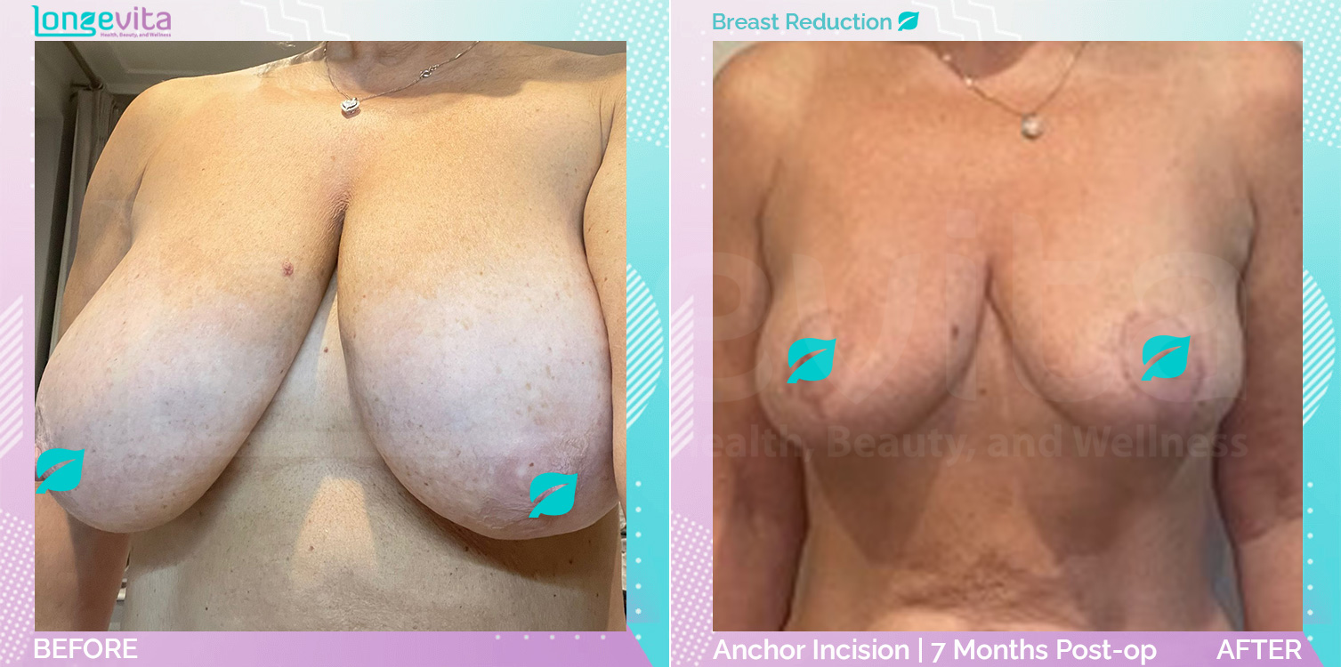 Breast Reduction before and after, Breast, 50s female patient
