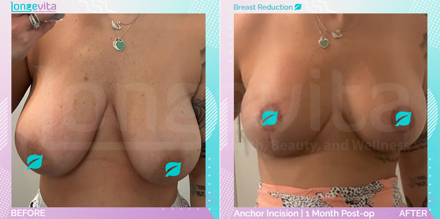 Breast Reduction before and after, Breast, 30s female patient