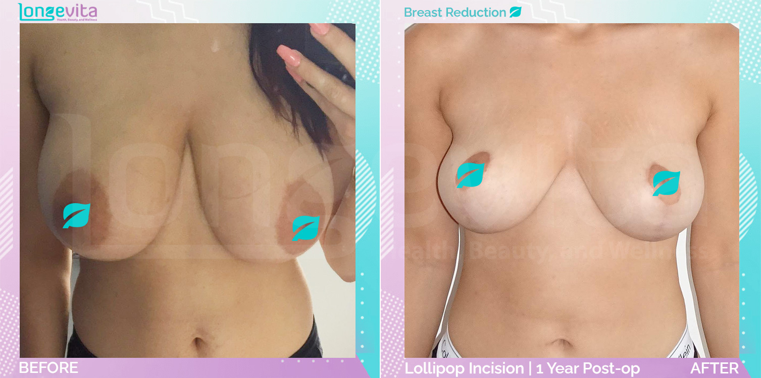 Breast Reduction before and after, Breast, 20s female patient