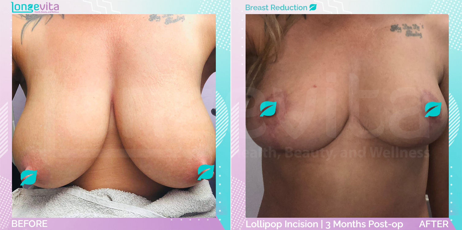 Breast Reduction before and after, Breast, 30s female patient