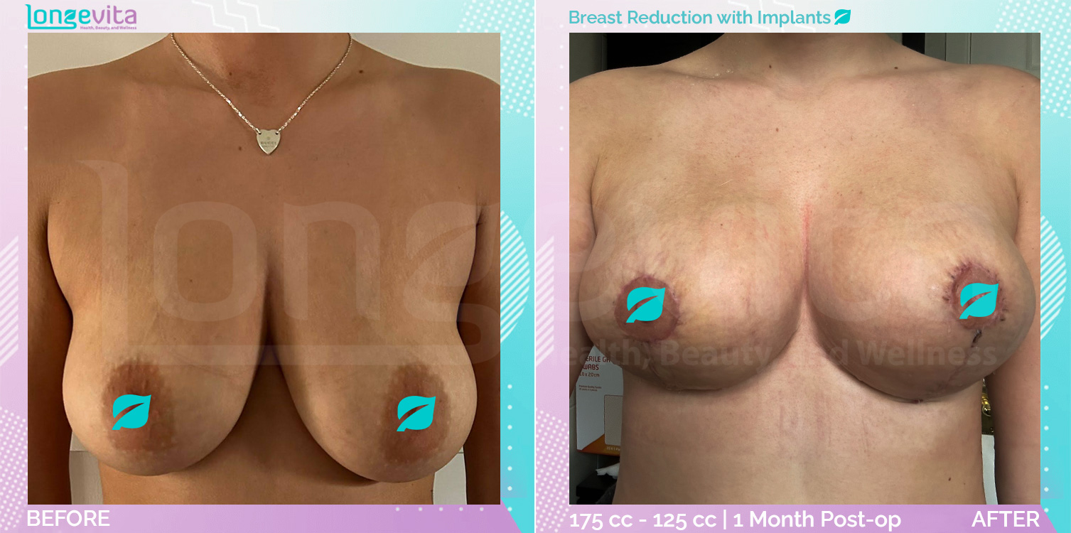Breast Implant and Breast Reduction before and after, Breast, 20s female patient