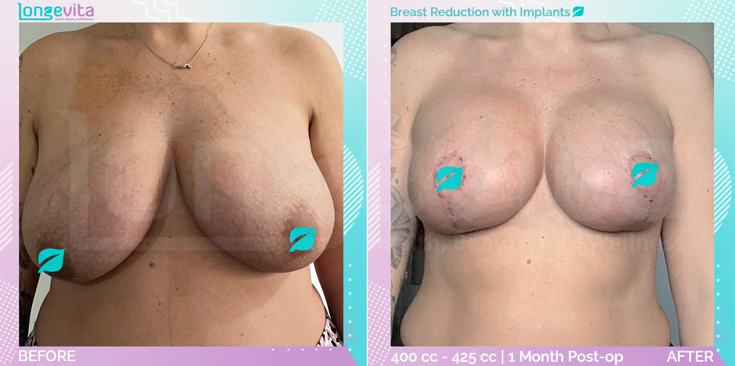 Breast Implant and Breast Reduction before and after, Breast, 30s female patient