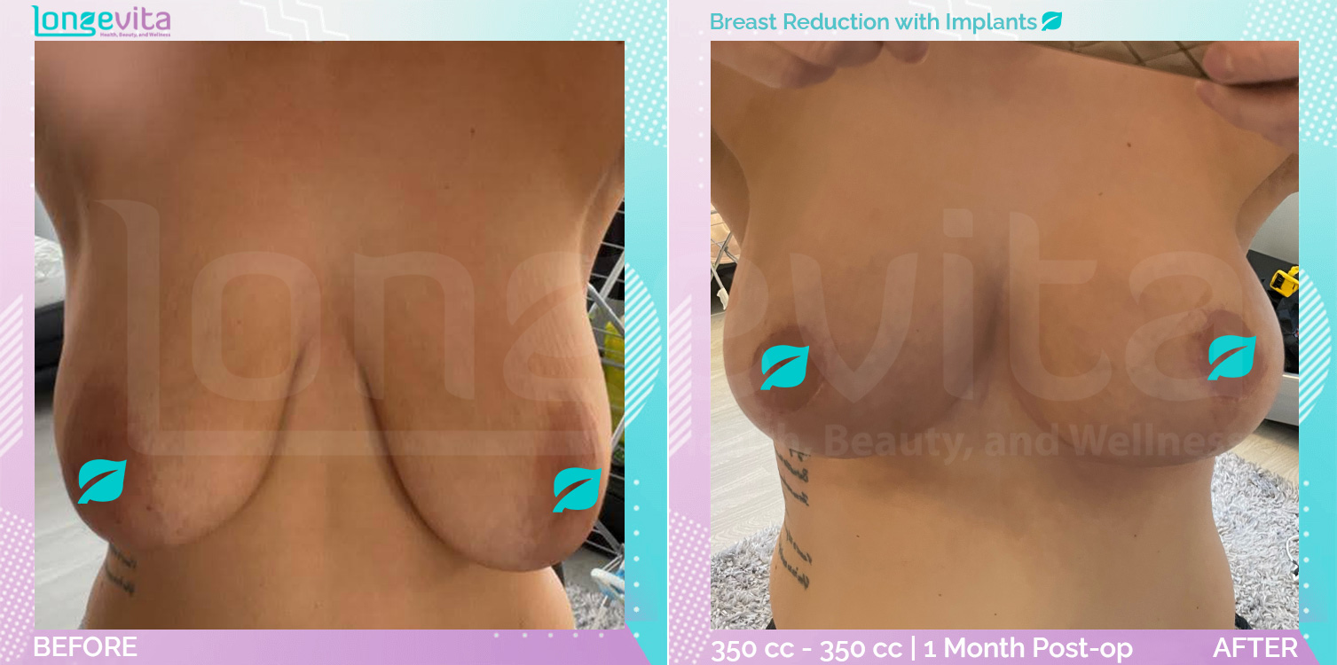 Breast Implant and Breast Reduction before and after, Breast, 20s female patient