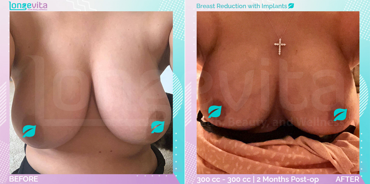 Breast Implant and Breast Reduction before and after, Breast, 20s female patient