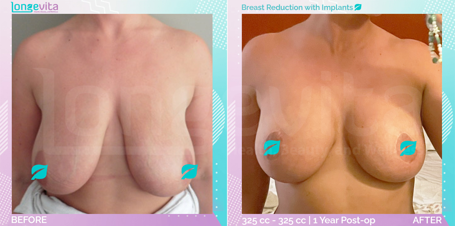 Breast Implant and Breast Reduction before and after, Breast, 20s female patient
