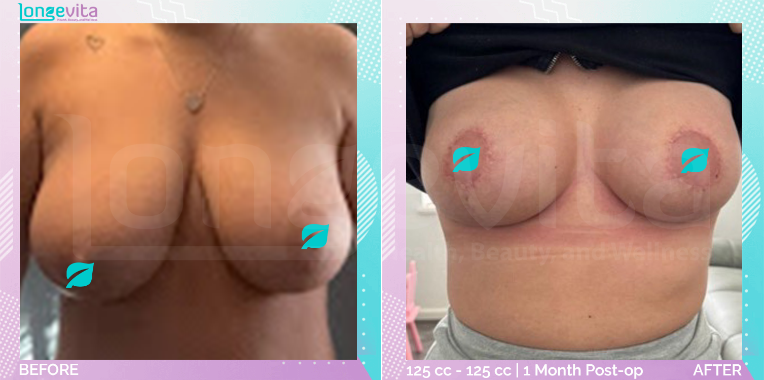 Breast Implant and Breast Reduction before and after, Breast, 20s female patient