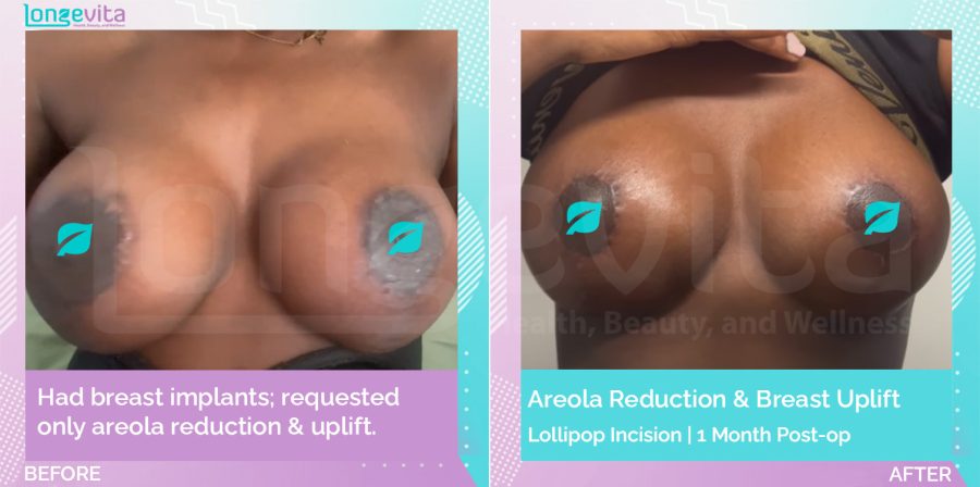 Areola Reduction and Breast Lift before and after, Breast, 20s female patient
