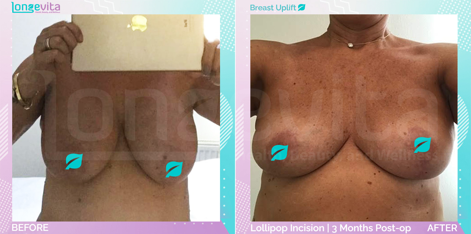 Breast Lift before and after, Breast