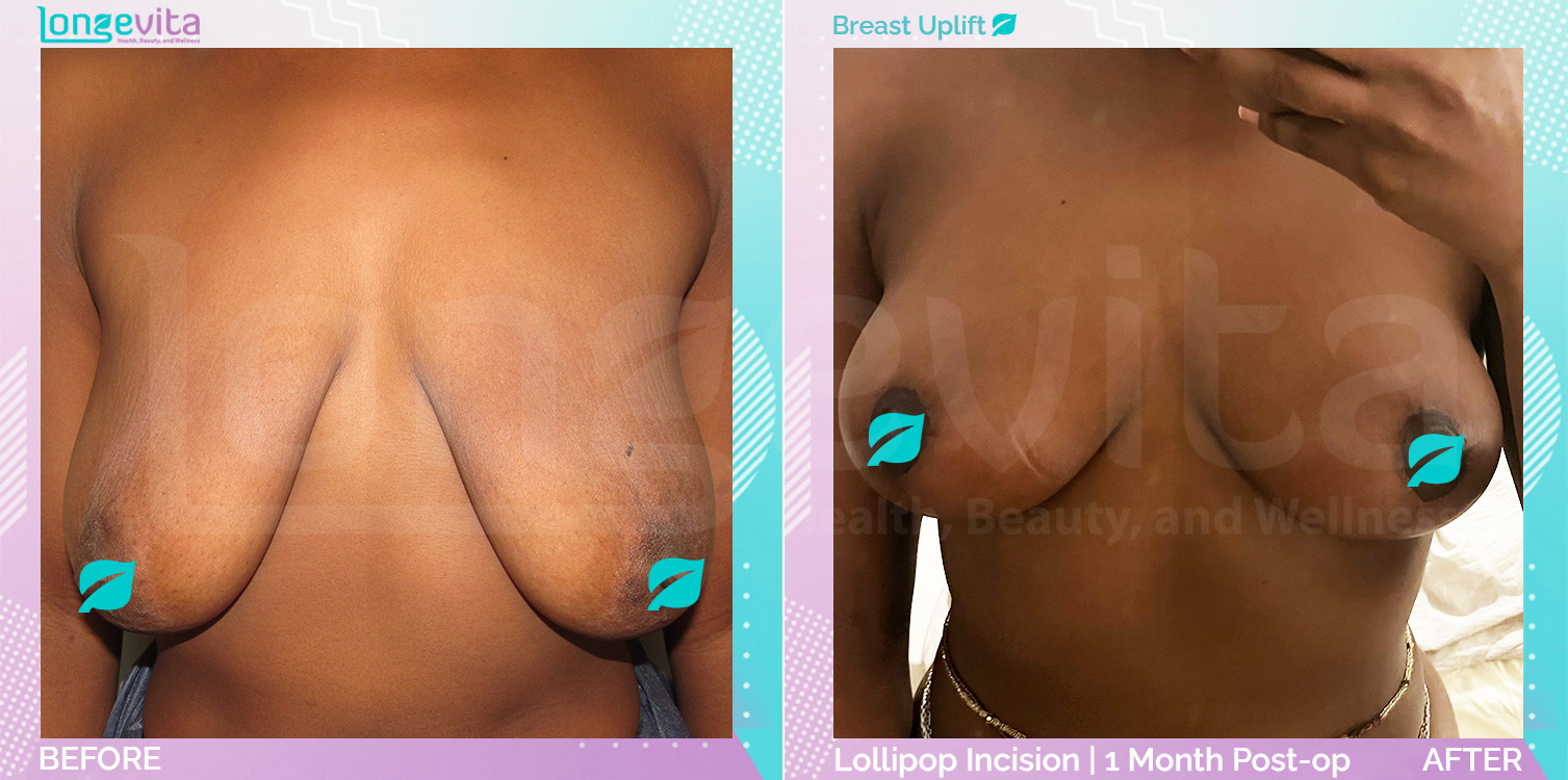 Breast Lift before and after, Breast, 20s female patient