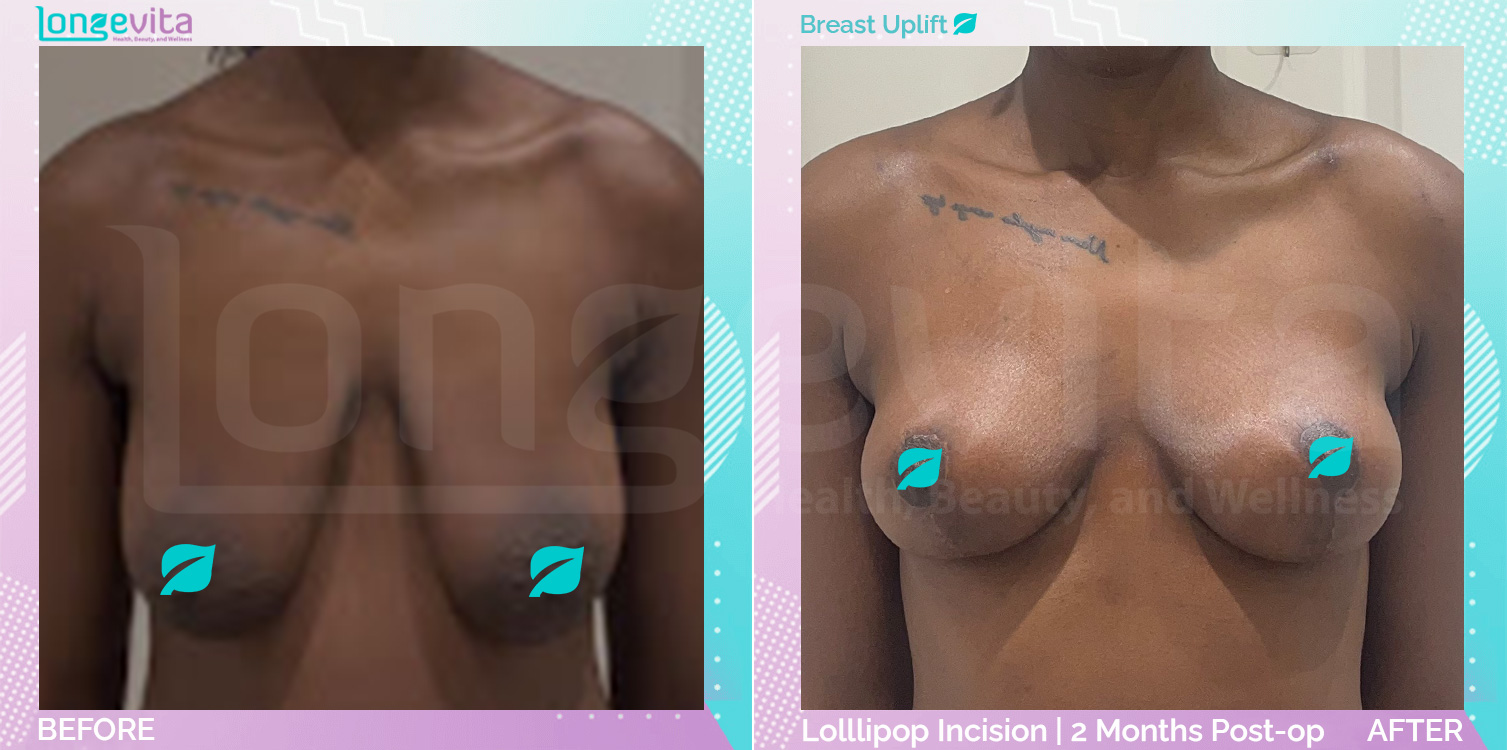 Breast Lift before and after, Breast, 20s female patient
