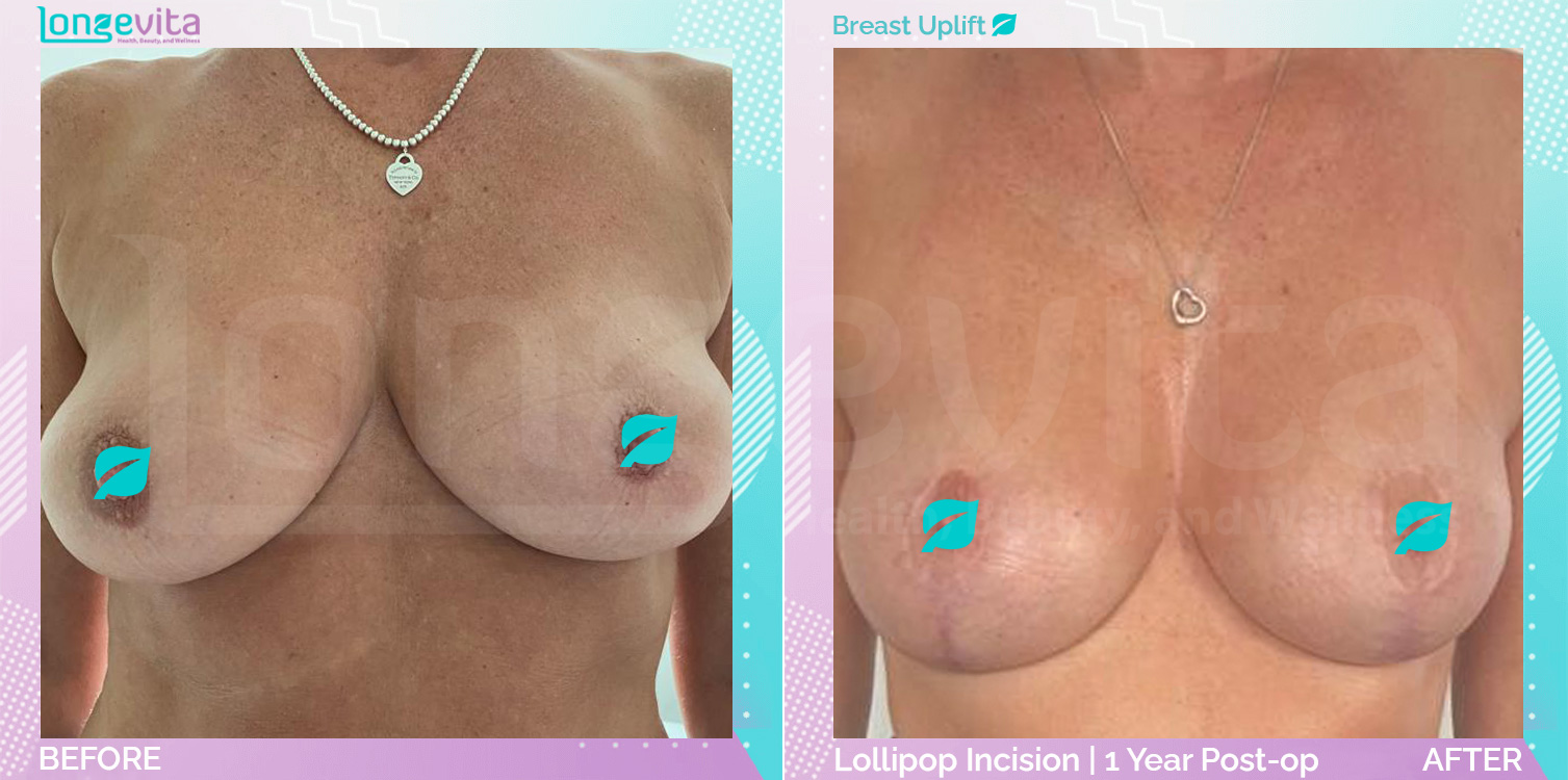 Breast Lift before and after, Breast, 50s female patient