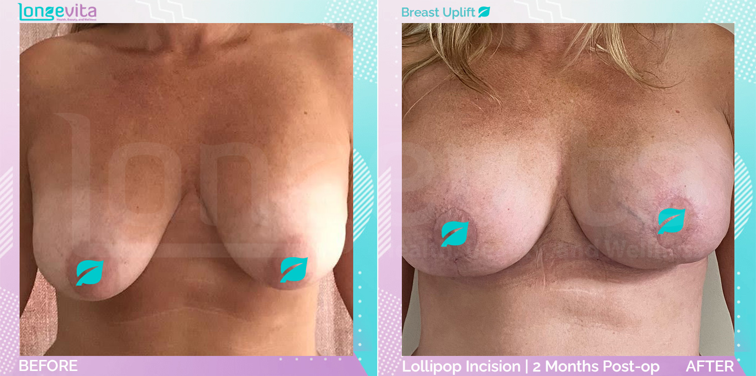 Breast Lift before and after, Breast, 40s female patient