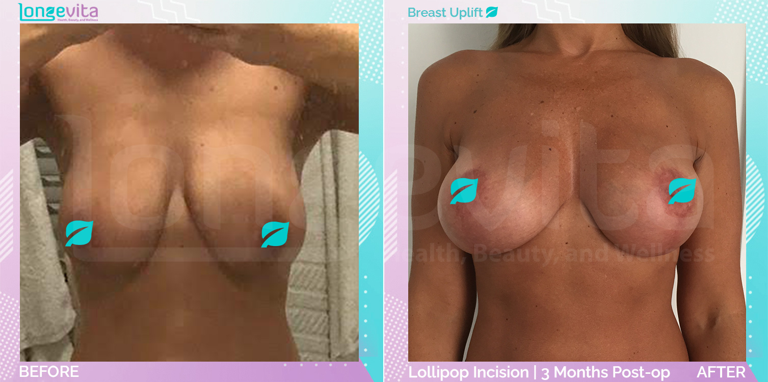 Breast Lift before and after, Breast, 30s female patient
