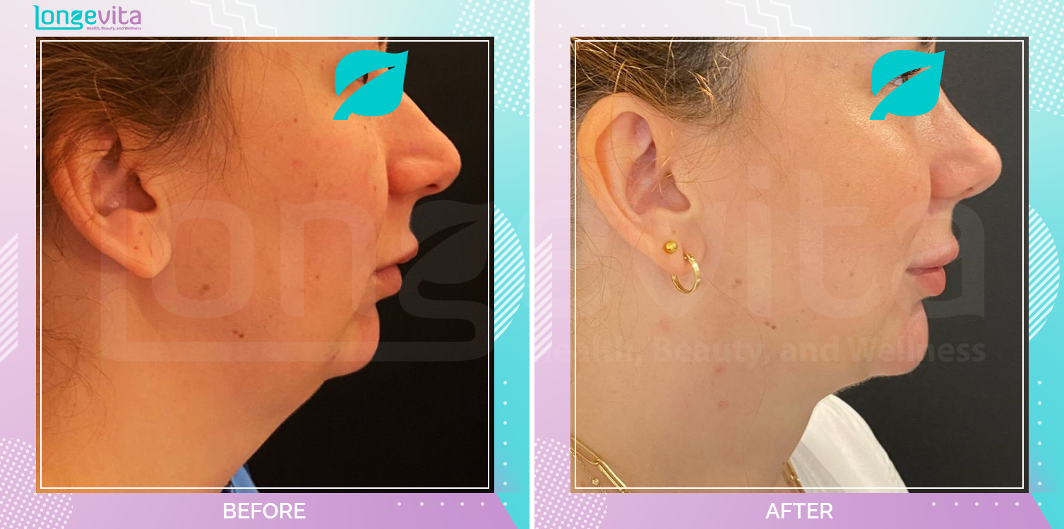 Liposuction before and after, Face